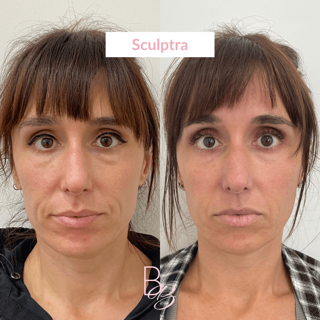 Before and After results of Sculptra treatment | Beauty Boost Med Spa in Newport Beach, CA