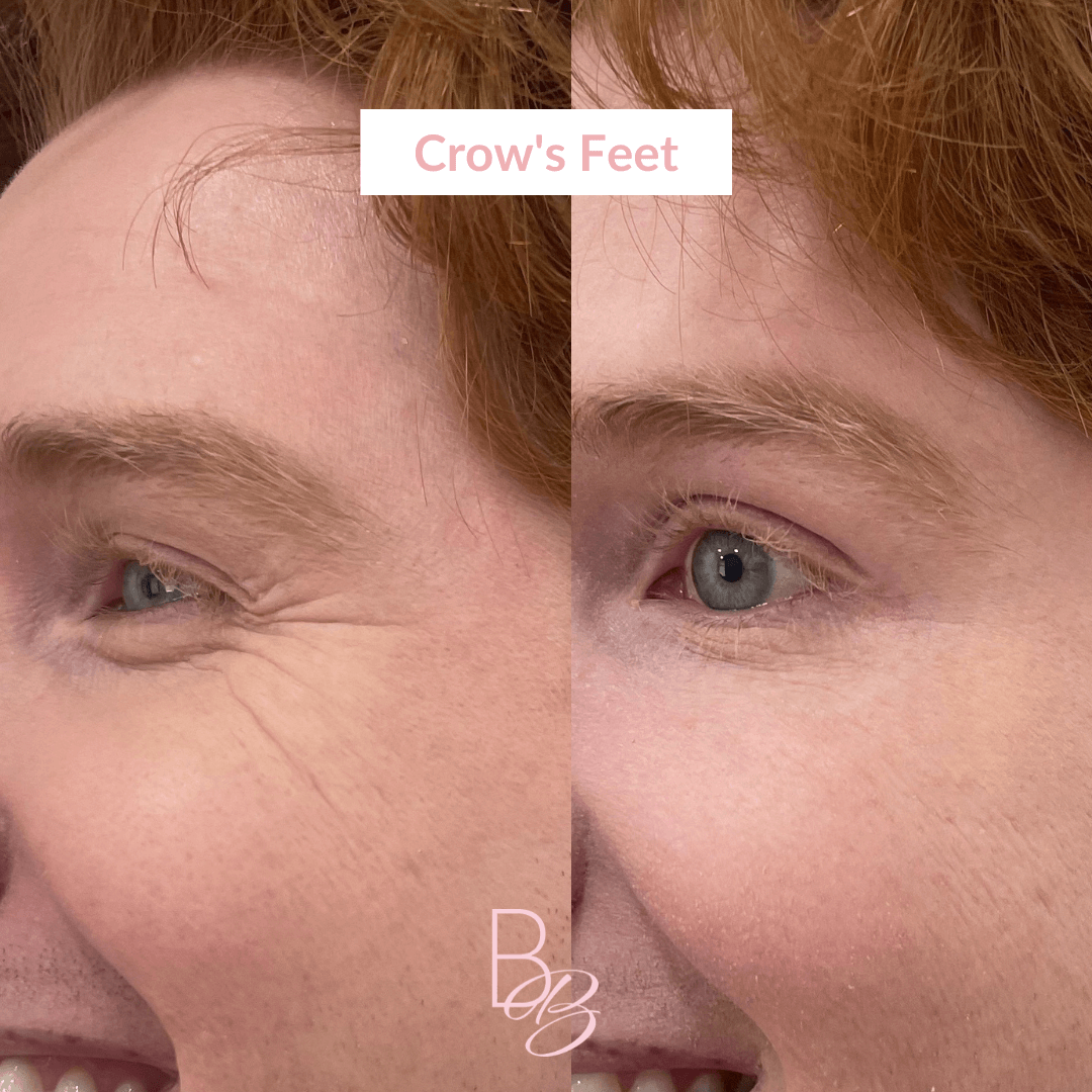 Before and After Crow's feet treatment result | Beauty Boost Med Spa in Newport Beach, CA