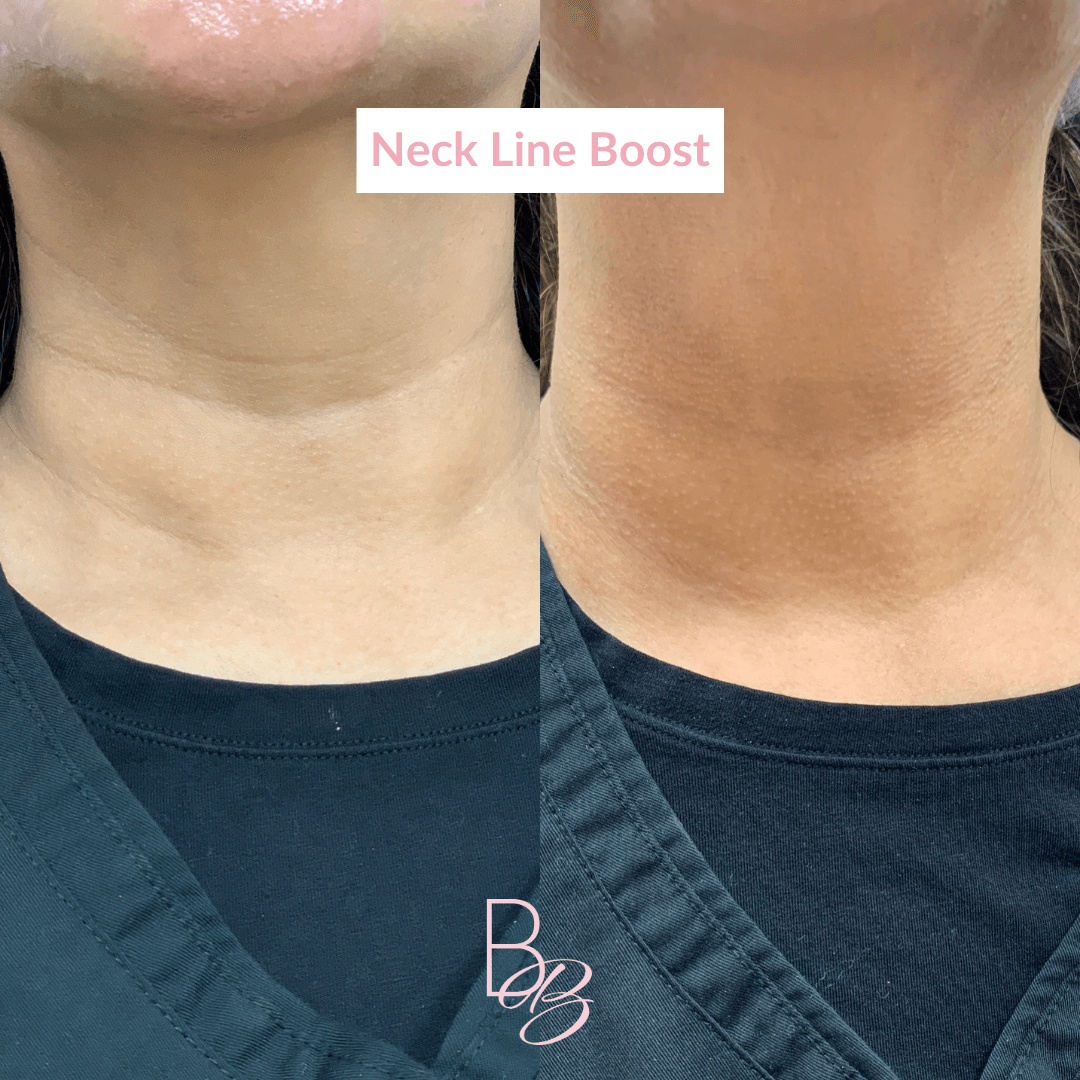 Before and After results of Neckline Boost treatment | Beauty Boost Med Spa in Newport Beach, CA