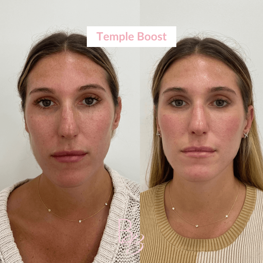 Before and After results of Temple Boost treatment | Beauty Boost Med Spa in Newport Beach, CA