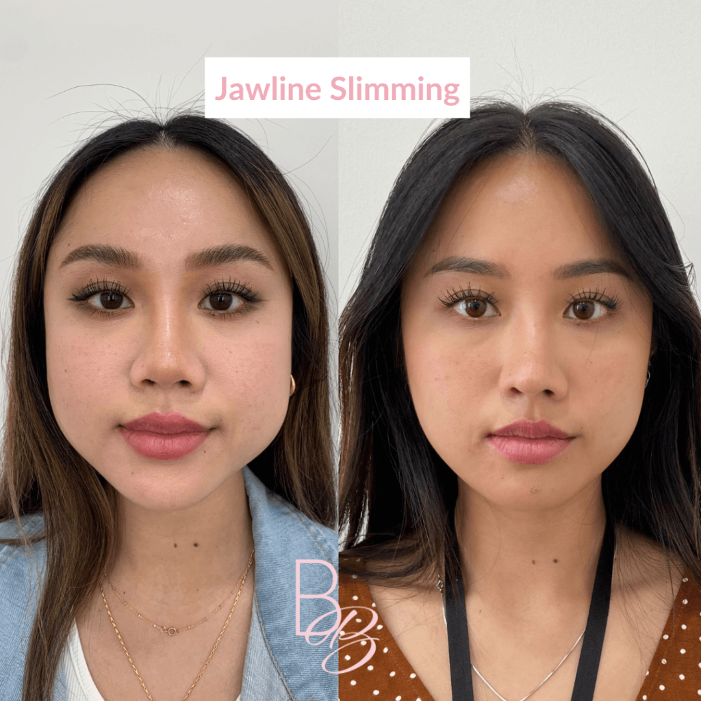 Before and After Jawline Slimming treatment result | Beauty Boost Med Spa in Newport Beach, CA