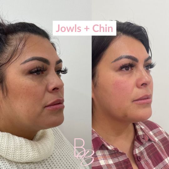 Before and After jowls and chin treatment result | Beauty Boost Med Spa in Newport Beach, CA