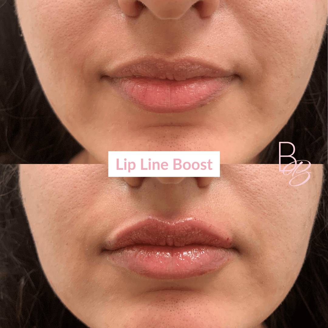 Before and After results of Lip Line Boost treatment | Beauty Boost Med Spa in Newport Beach, CA