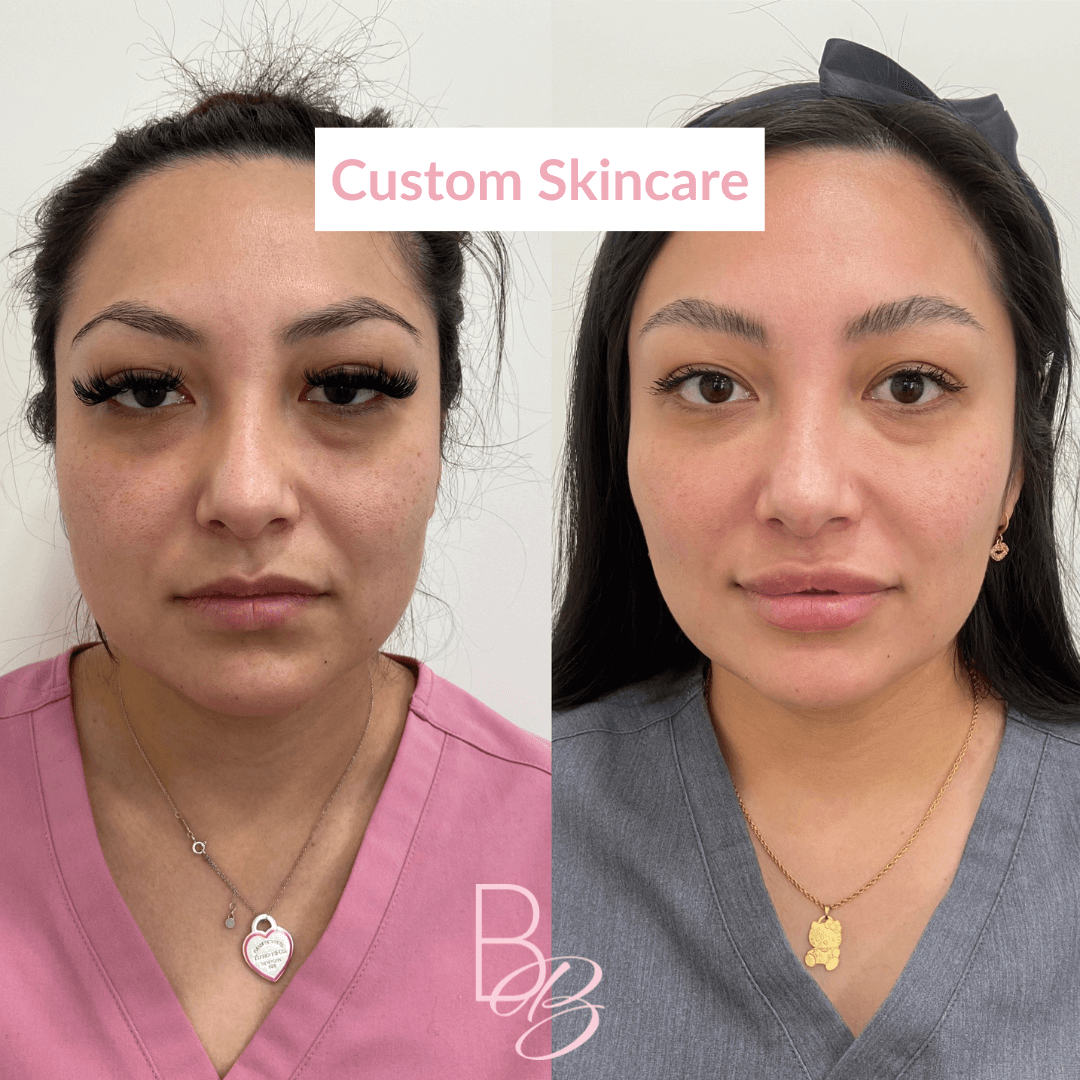 Before and After results of Custom Skincare treatment | Beauty Boost Med Spa in Newport Beach, CA