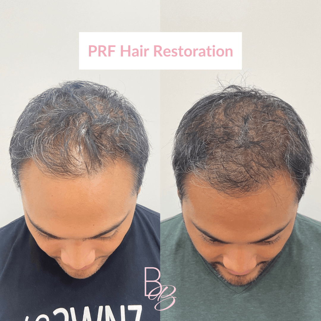 Before and After results of PRP Hair Restoration treatment | Beauty Boost Med Spa in Newport Beach, CA