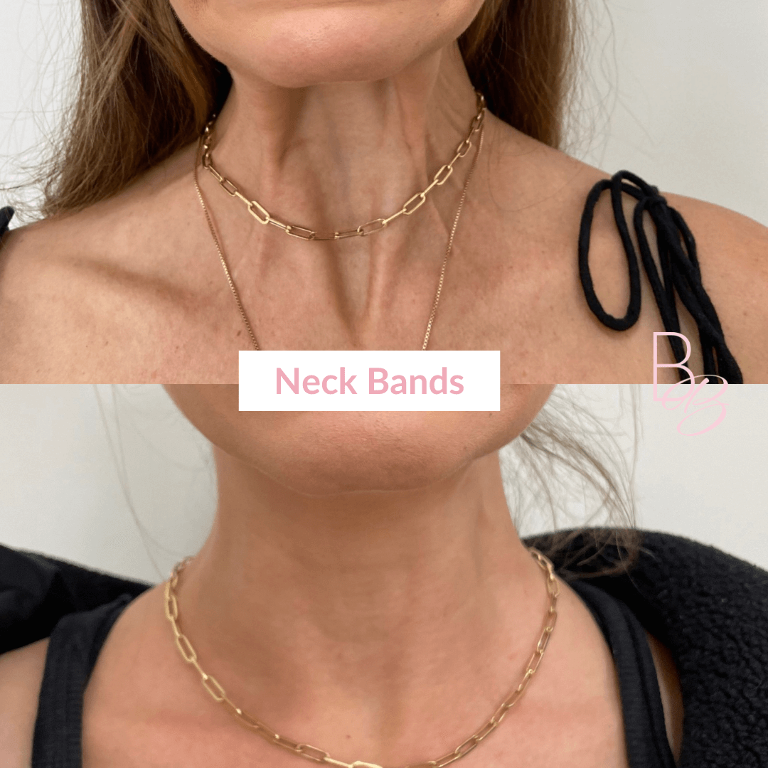 Before and After results of Neck Bands treatment | Beauty Boost Med Spa in Newport Beach, CA