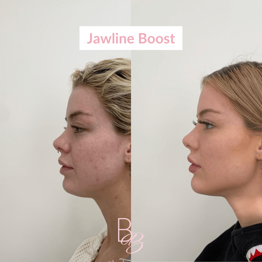 Before and After results of Jawline Boost treatment | Beauty Boost Med Spa in Newport Beach, CA