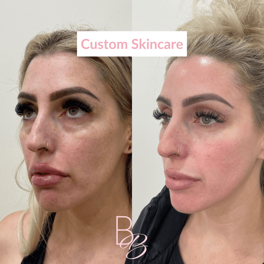 Before and After results of Custom Skincare treatment | Beauty Boost Med Spa in Newport Beach, CA