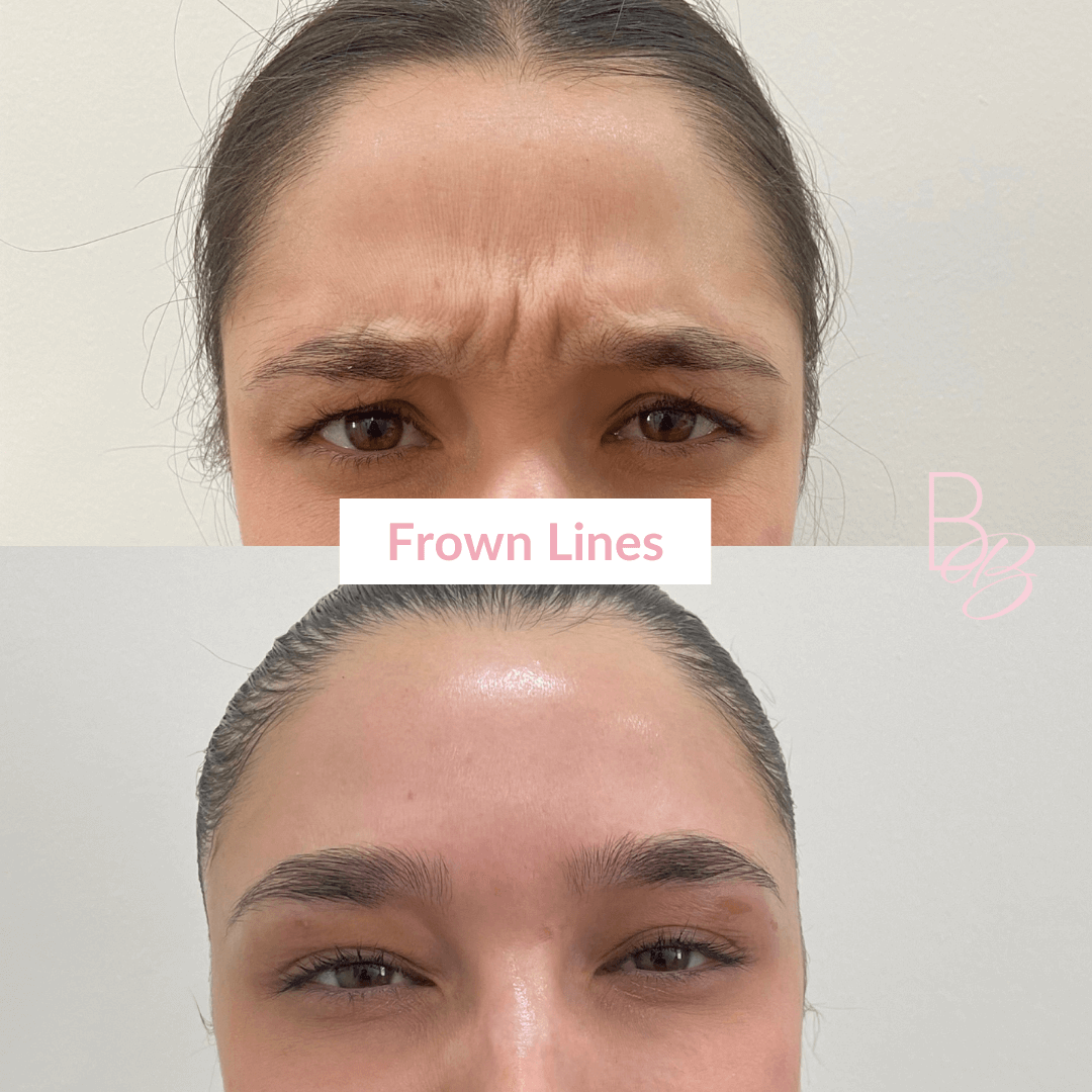 Before and After Frown Lines treatment result | Beauty Boost Med Spa in Newport Beach, CA