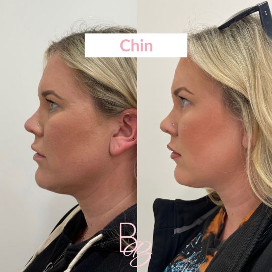 Before and After chin treatment result | Beauty Boost Med Spa in Newport Beach, CA