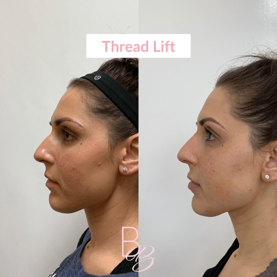 Before and After results of Thread Lift treatment | Beauty Boost Med Spa in Newport Beach, CA