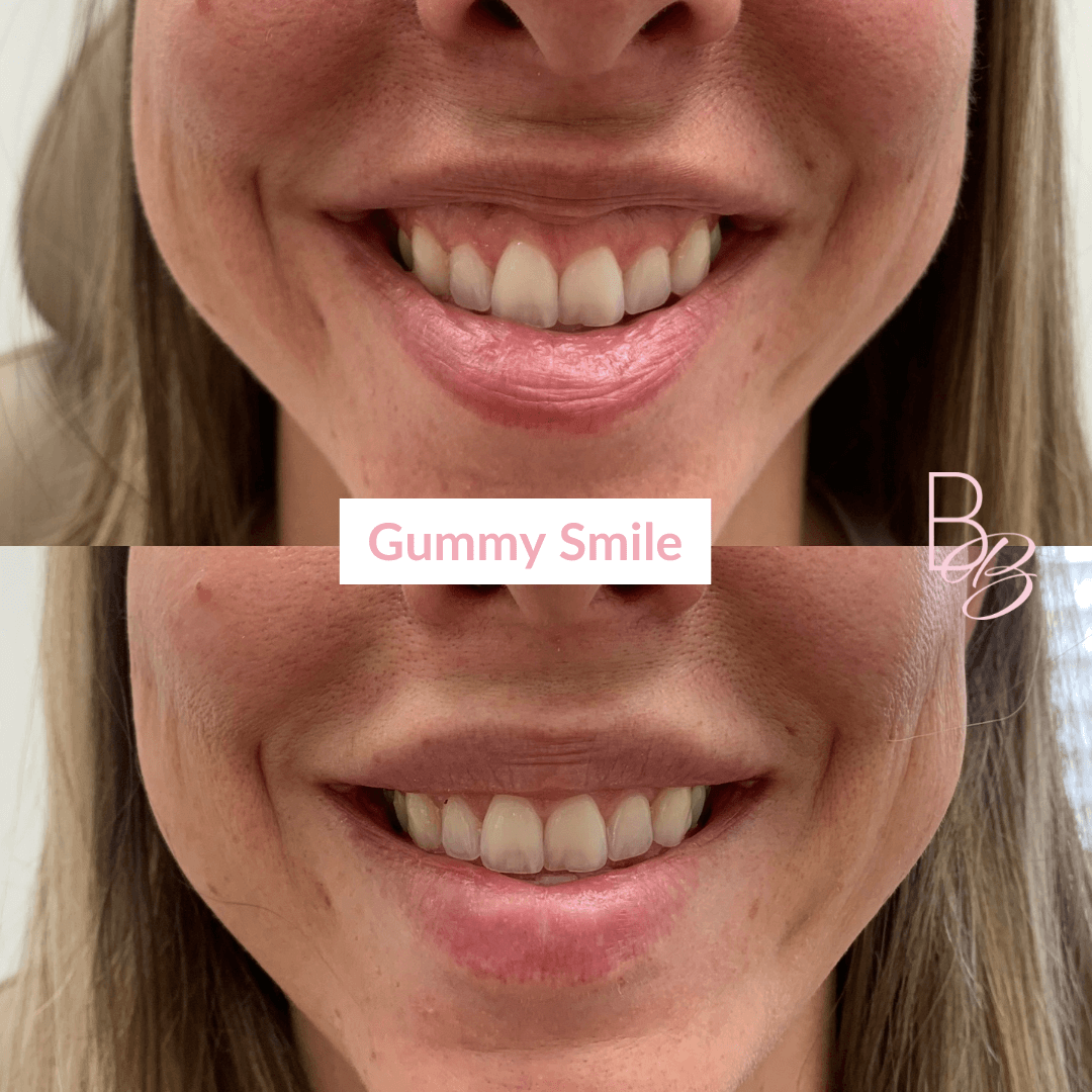 Before and After Gummy Smile treatment result | Beauty Boost Med Spa in Newport Beach, CA