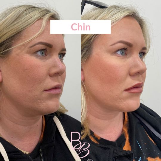 Before and After chin treatment result | Beauty Boost Med Spa in Newport Beach, CA