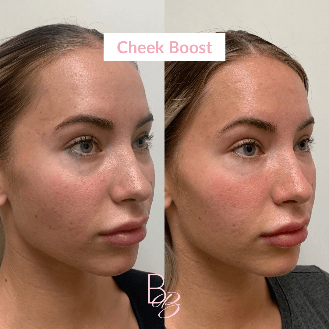 Before and After results of Cheek Boost treatment | Beauty Boost Med Spa in Newport Beach, CA