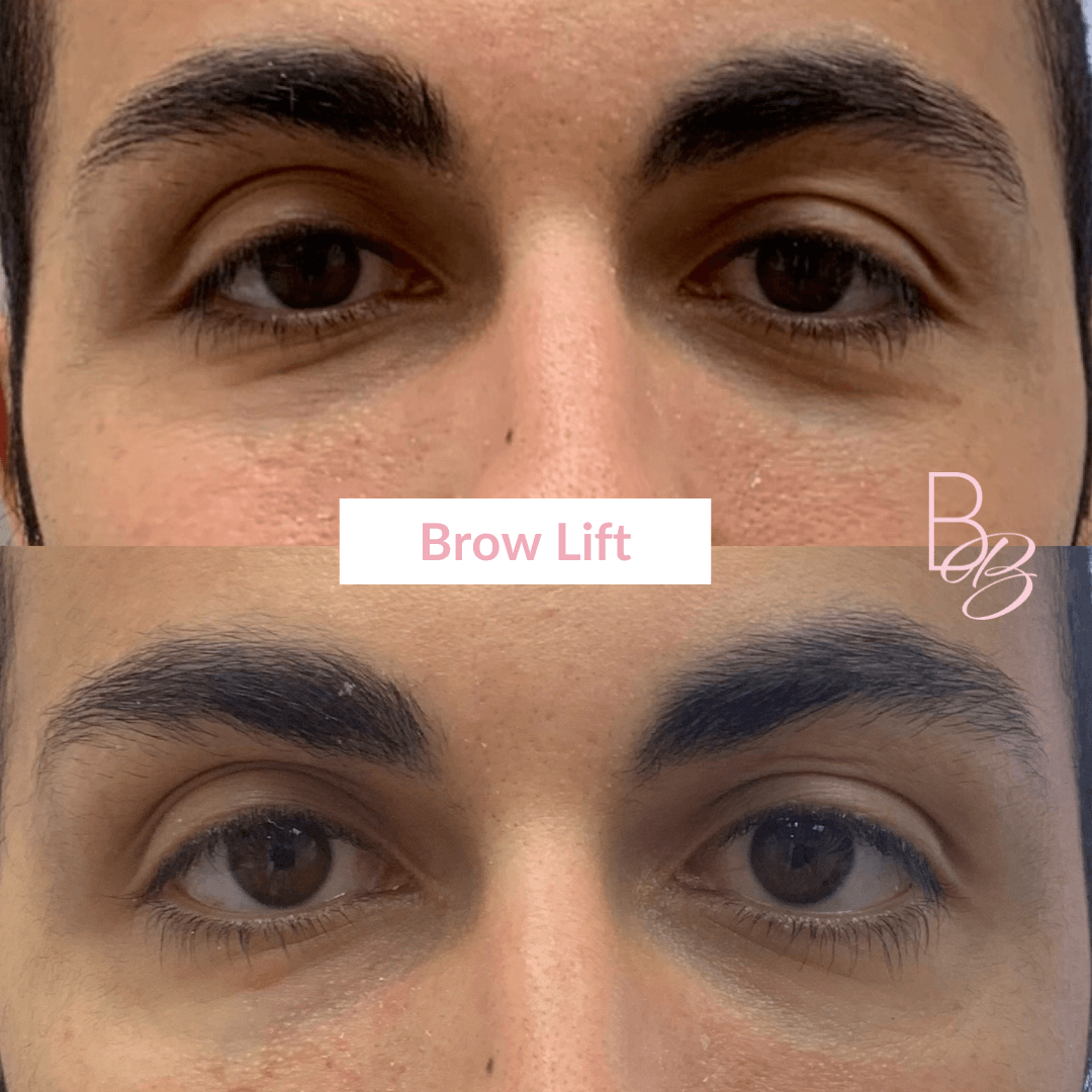 Before and After Brow Lift treatment result | Beauty Boost Med Spa in Newport Beach, CA