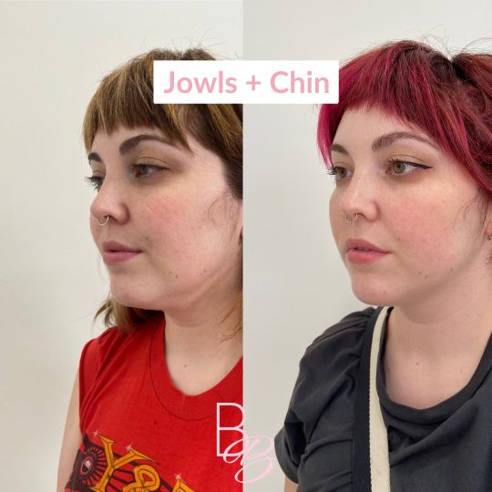 Before and After Jowls and chin treatment result | Beauty Boost Med Spa in Newport Beach, CA