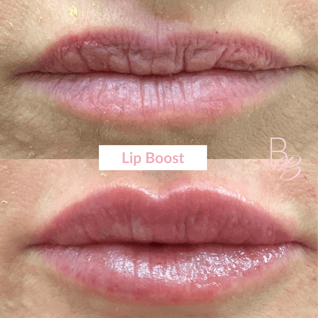 Before and After results of Lip Boost treatment | Beauty Boost Med Spa in Newport Beach, CA