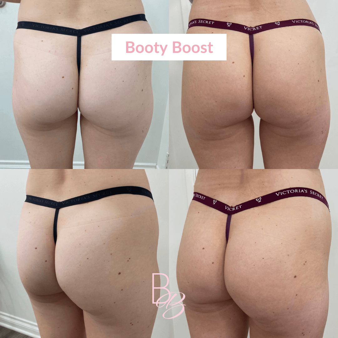 Before and After results of Booty Boost treatment | Beauty Boost Med Spa in Newport Beach, CA
