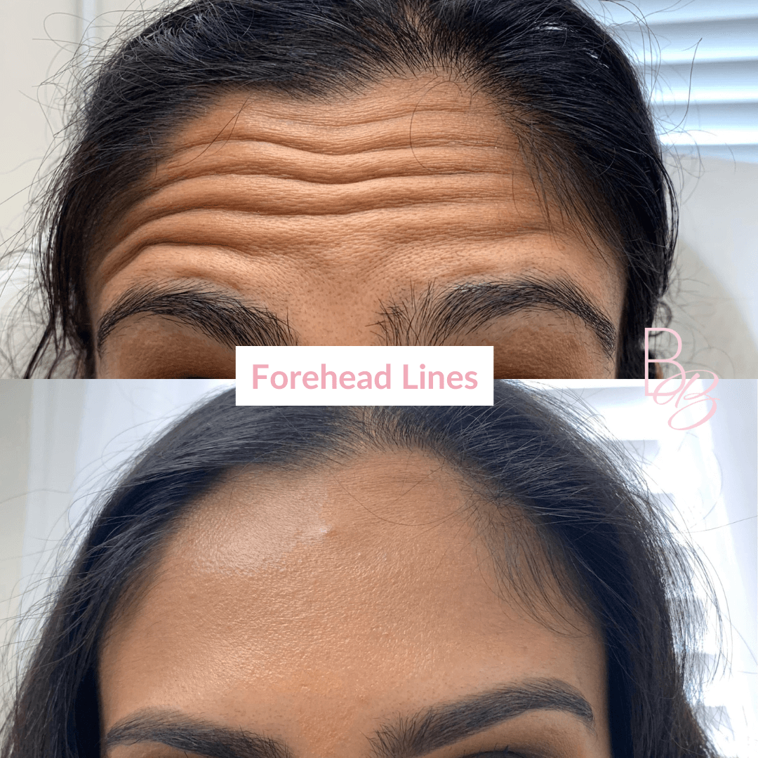 Before and After Forehead Lines treatment result | Beauty Boost Med Spa in Newport Beach, CA