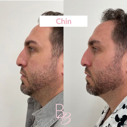 Before and After Chin treatment result of a man | Beauty Boost Med Spa in Newport Beach, CA