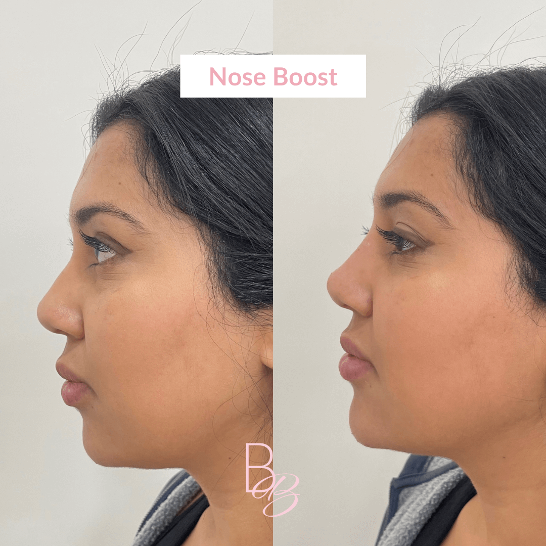 Before and After results of Nose Boost treatment | Beauty Boost Med Spa in Newport Beach, CA