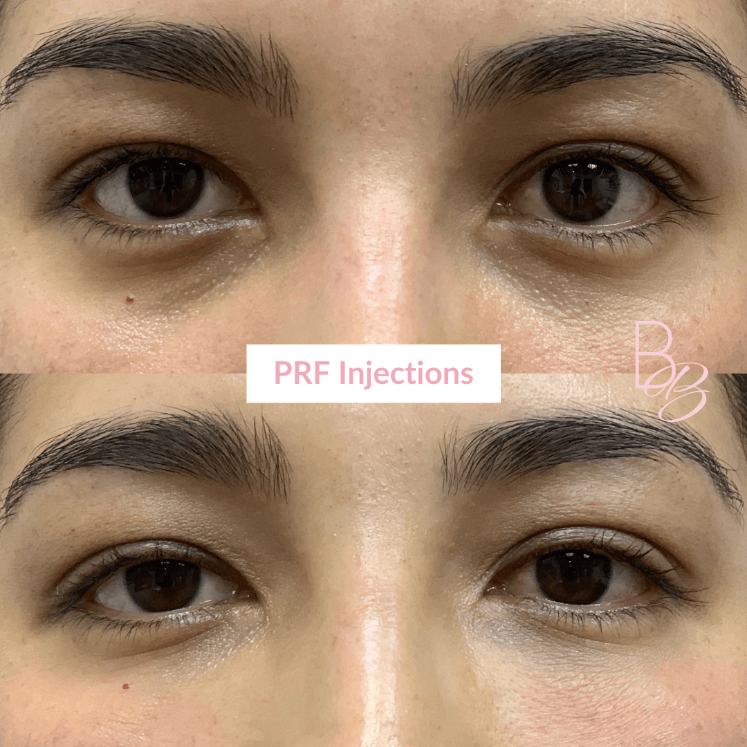 Before and After results of PRF Injections treatment | Beauty Boost Med Spa in Newport Beach, CA