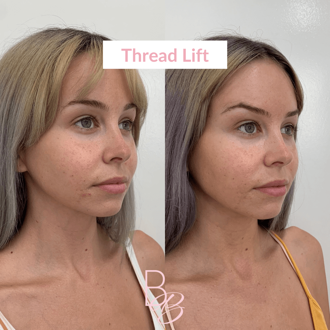 Before and After results of Thread Lift treatment | Beauty Boost Med Spa in Newport Beach, CA