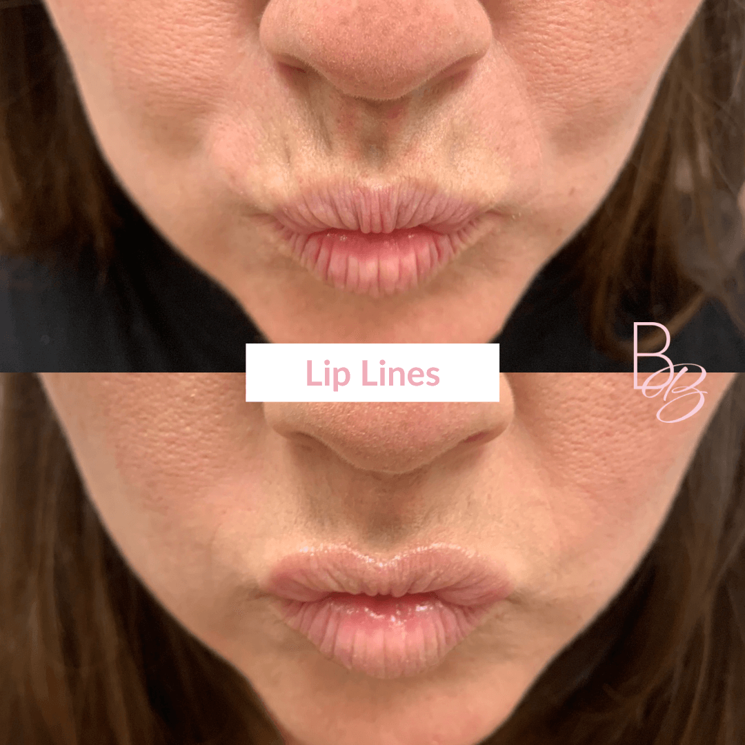 Before and After Lip Line treatment result | Beauty Boost Med Spa in Newport Beach, CA