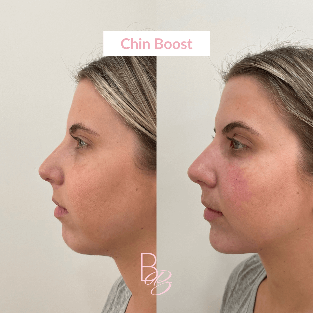 Before and After results of Chin Boost treatment | Beauty Boost Med Spa in Newport Beach, CA