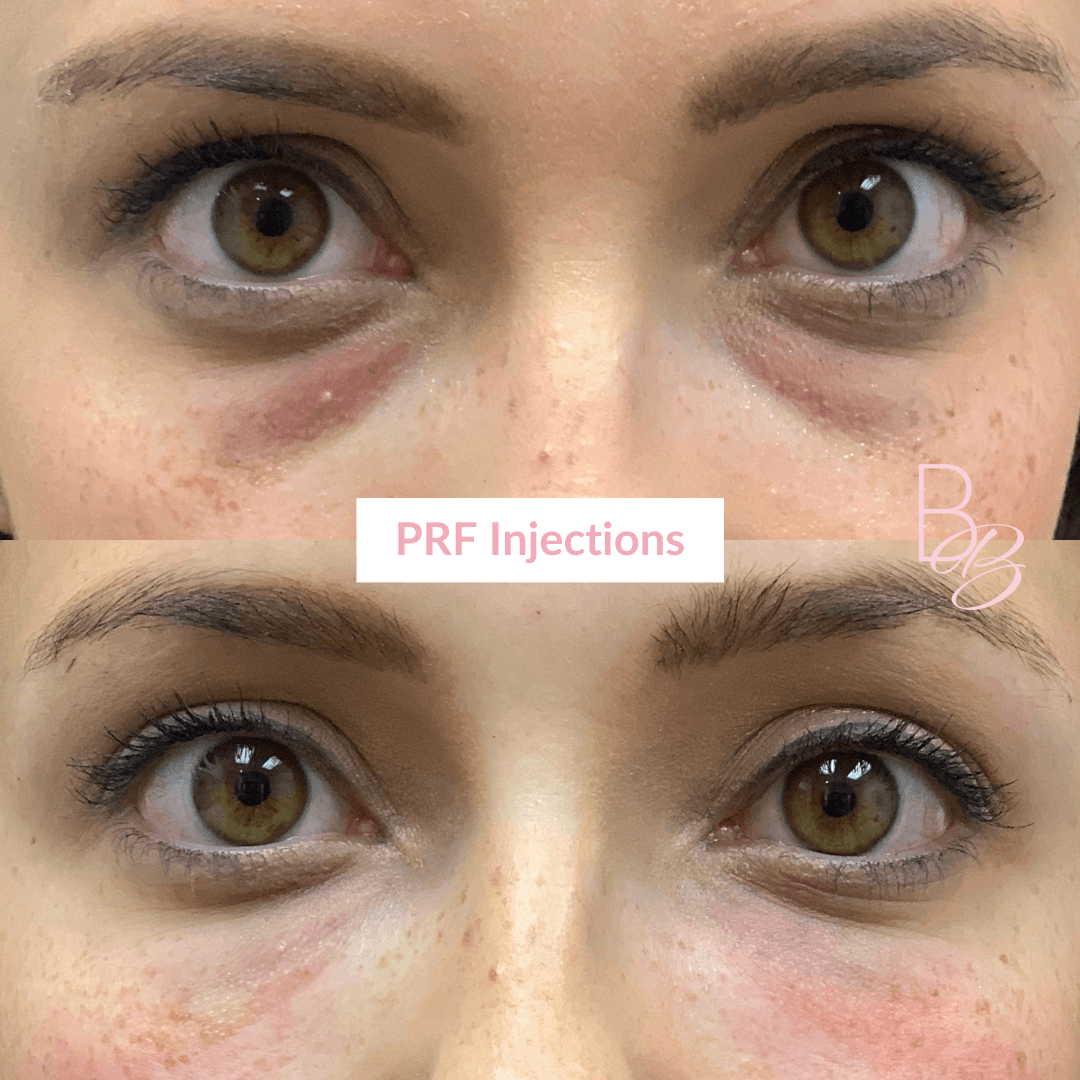 Before and After results of PRF Injections treatment | Beauty Boost Med Spa in Newport Beach, CA