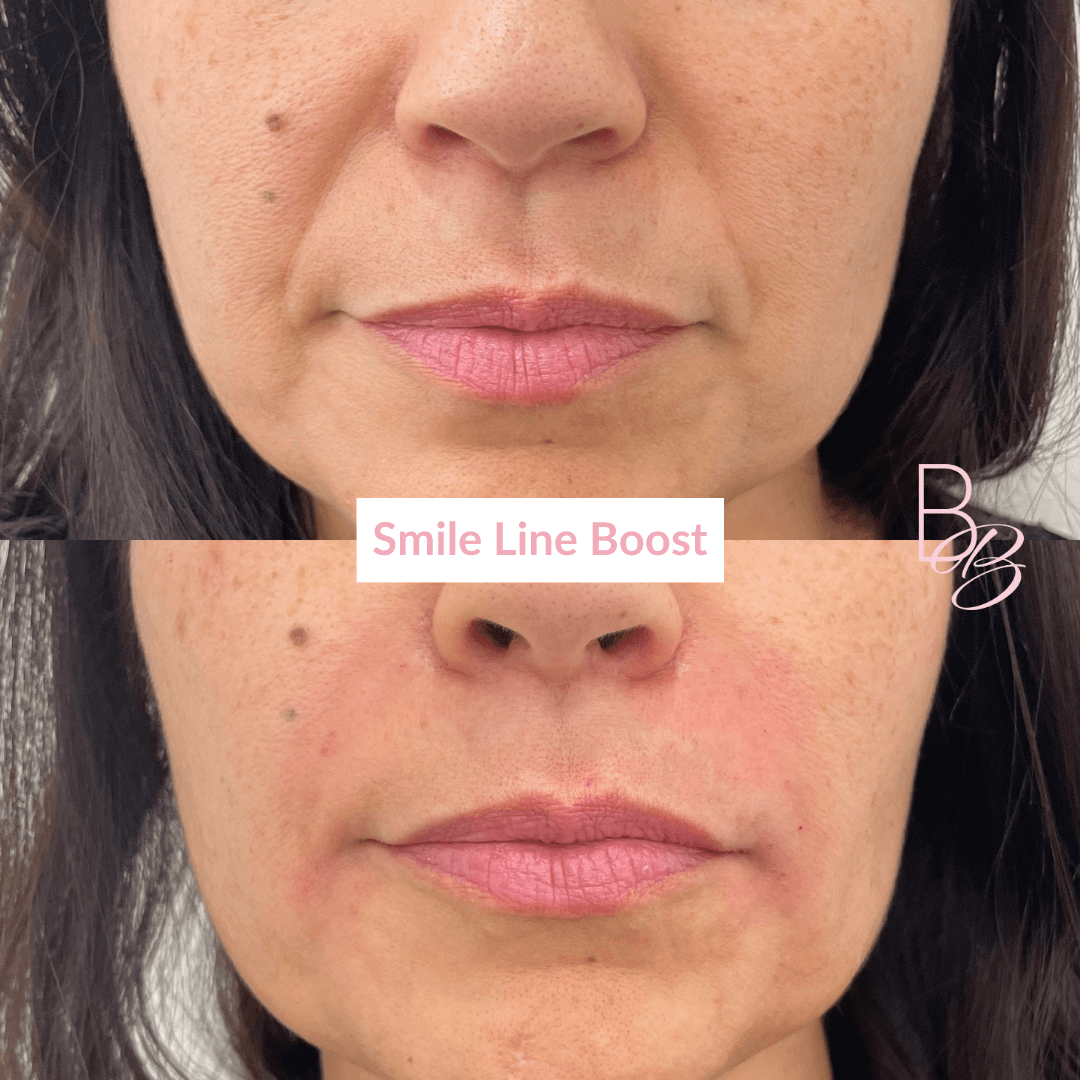 Before and After results of Smile line Boost treatment | Beauty Boost Med Spa in Newport Beach, CA