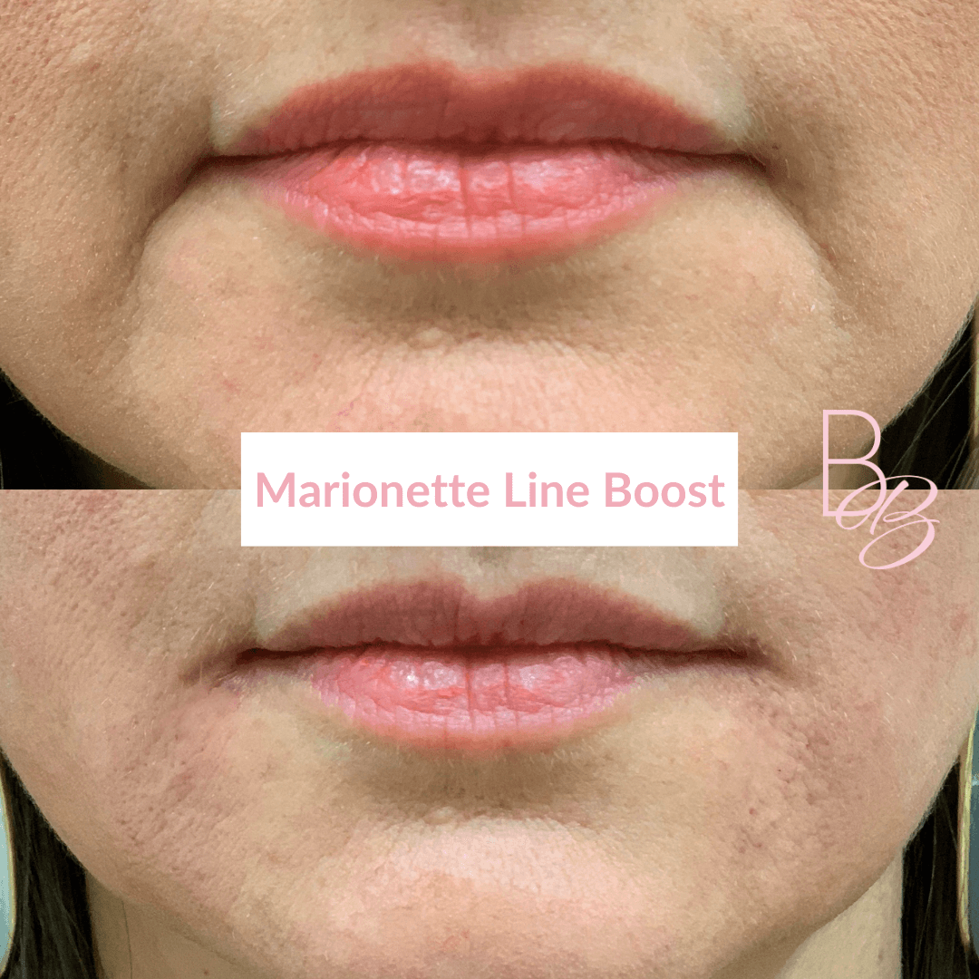 Before and After results of Marionette Line Boost treatment | Beauty Boost Med Spa in Newport Beach, CA