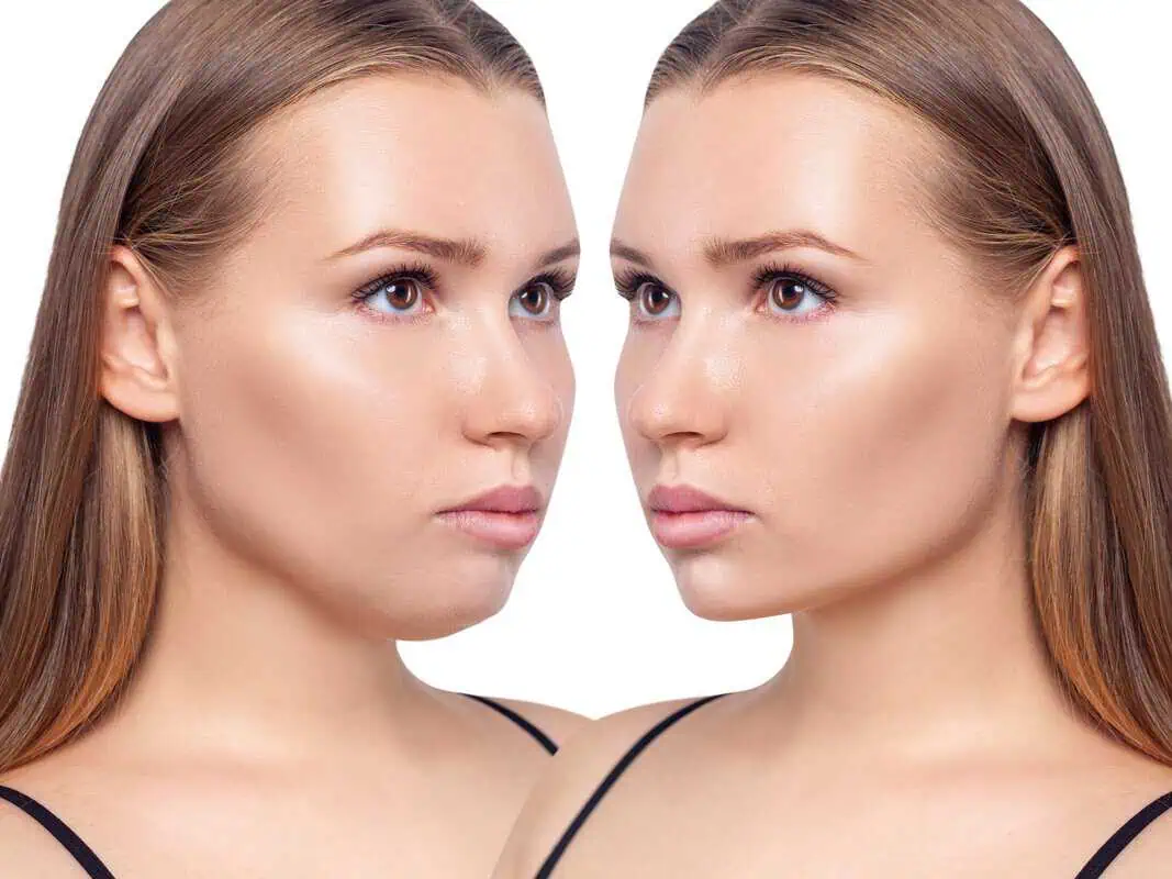 Kybella treatment by Beauty Boost Med Spa in Newport Beach, CA