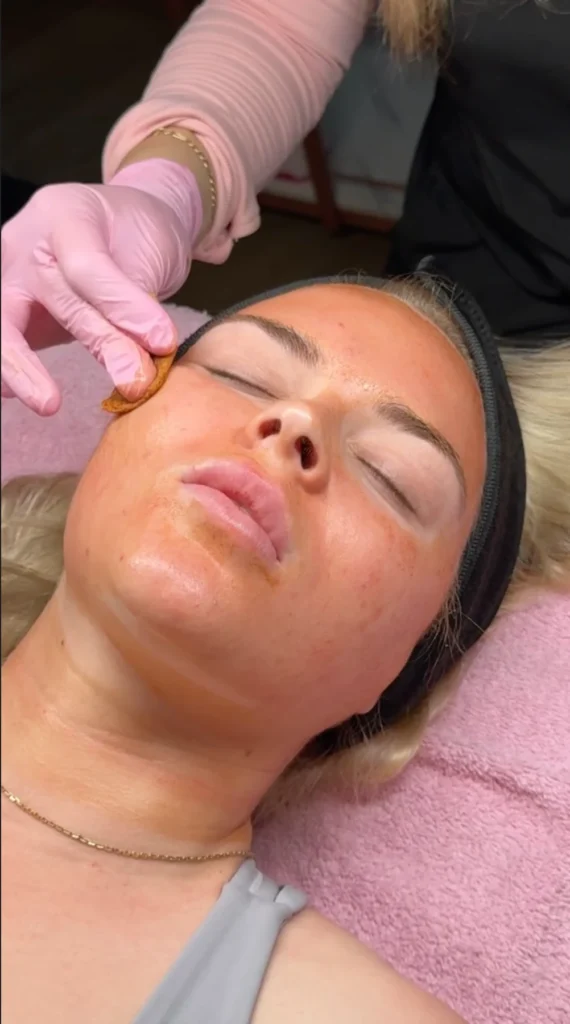 beautyboostmedspa chemical peels aa