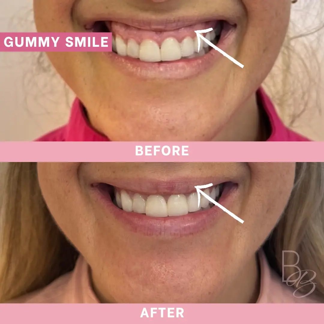 Before and After Gummy Smile | Beauty Boost Med Spa in Newport Beach, CA