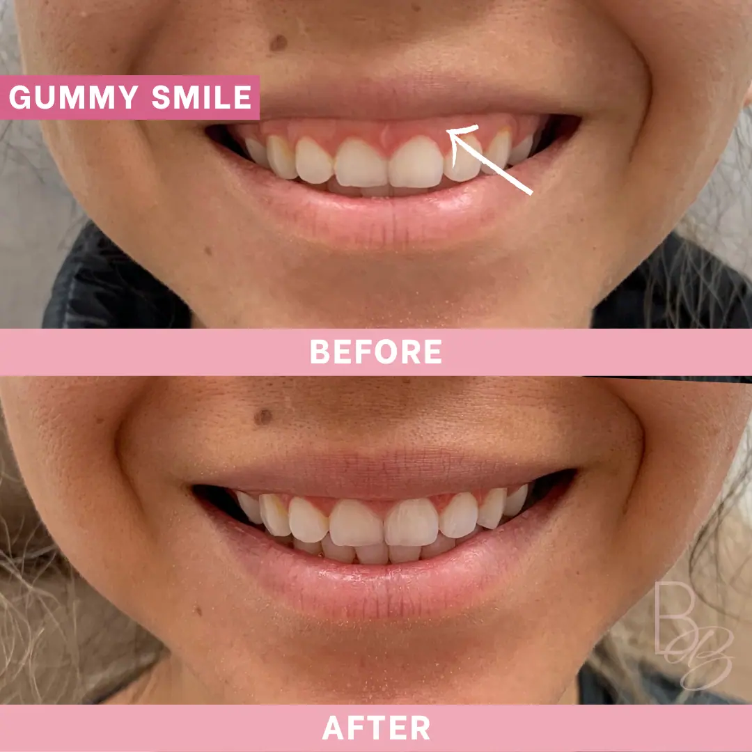 Before and After Gummy Smile | Beauty Boost Med Spa in Newport Beach, CA