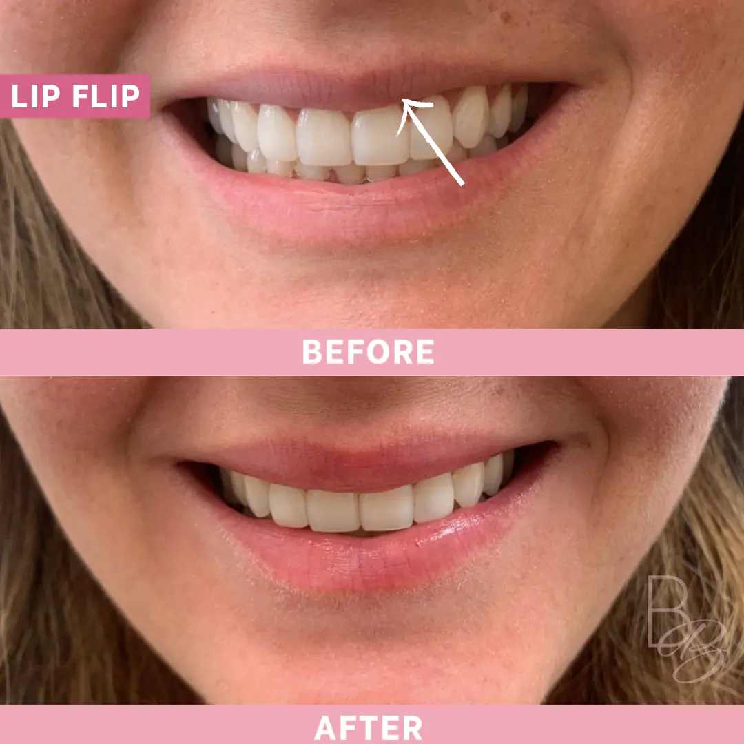 Before and After Lip Flip | Beauty Boost Med Spa in Newport Beach, CA