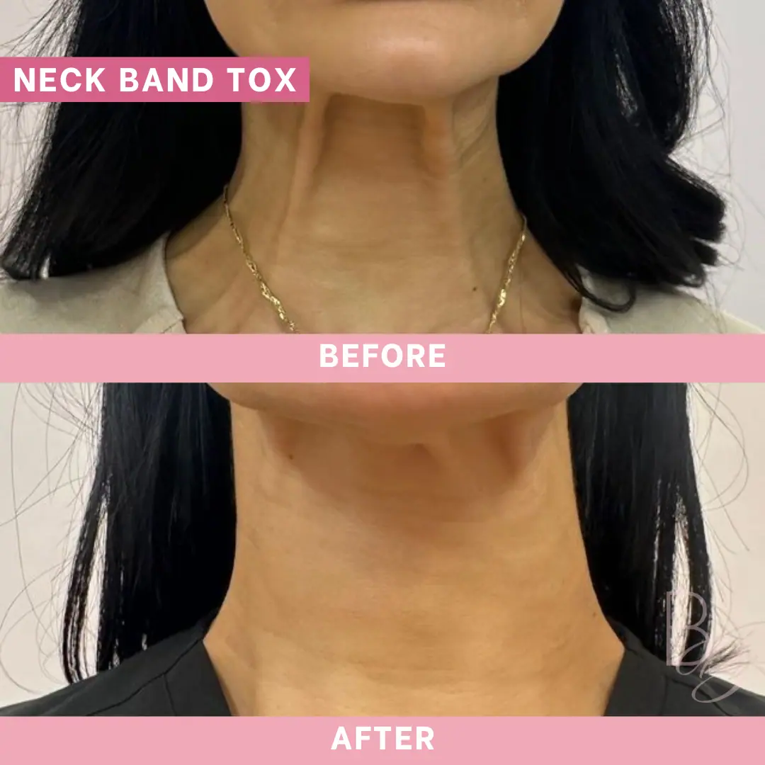 Before and After Neck Band Tox | Beauty Boost Med Spa in Newport Beach, CA