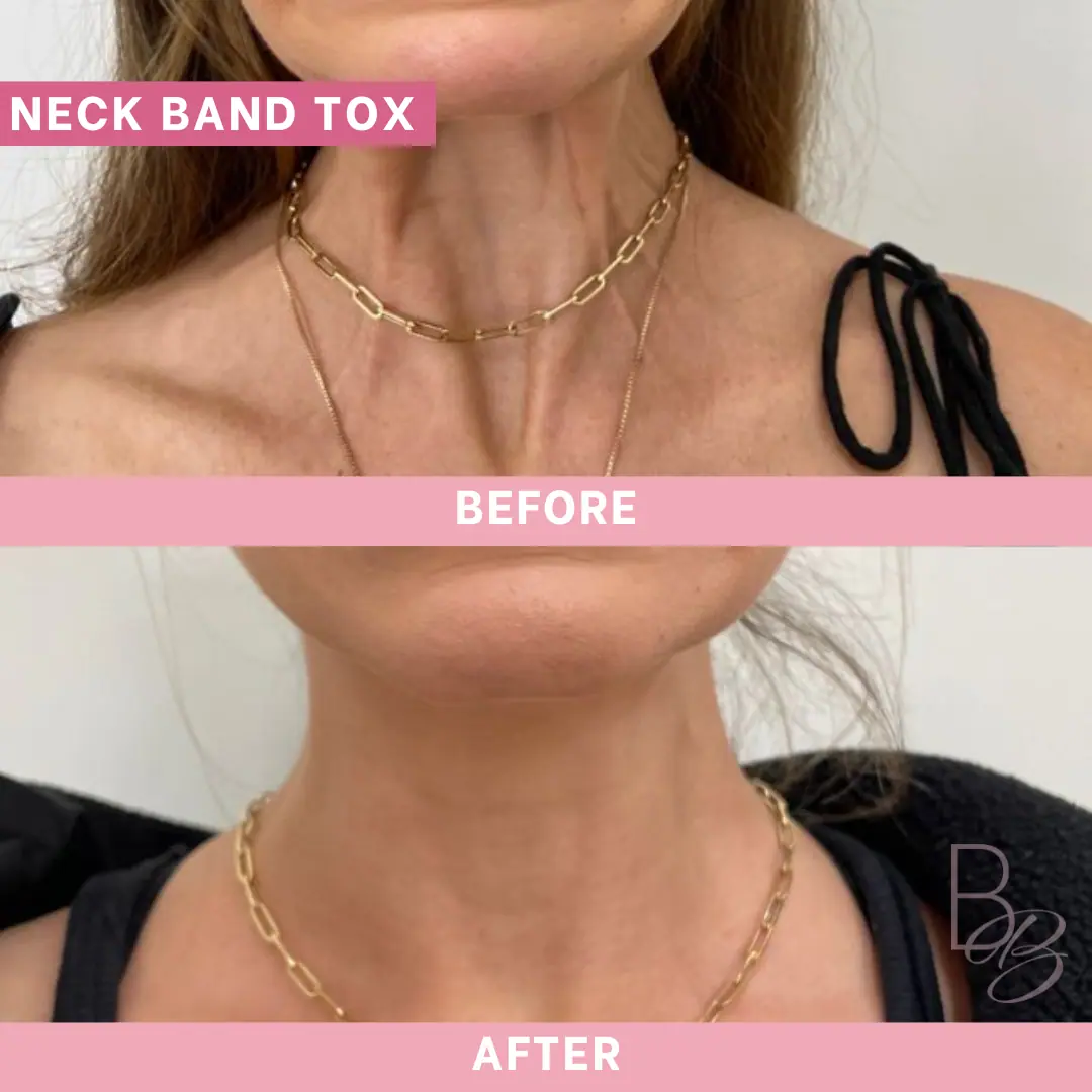 Before and After Neck Band Tox | Beauty Boost Med Spa in Newport Beach, CA