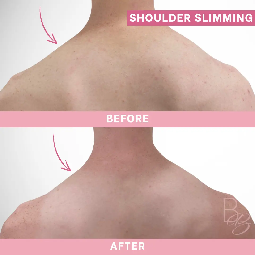 Before and After Shoulder Slimming | Beauty Boost Med Spa in Newport Beach, CA