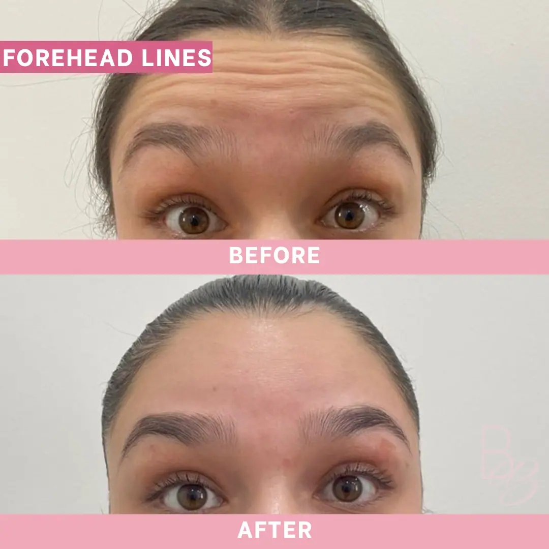 Before and After Forehead Lines | Beauty Boost Med Spa in Newport Beach, CA