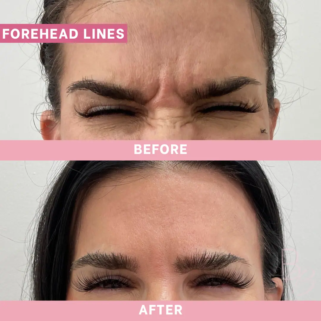 Before and After Forehead Lines | Beauty Boost Med Spa in Newport Beach, CA