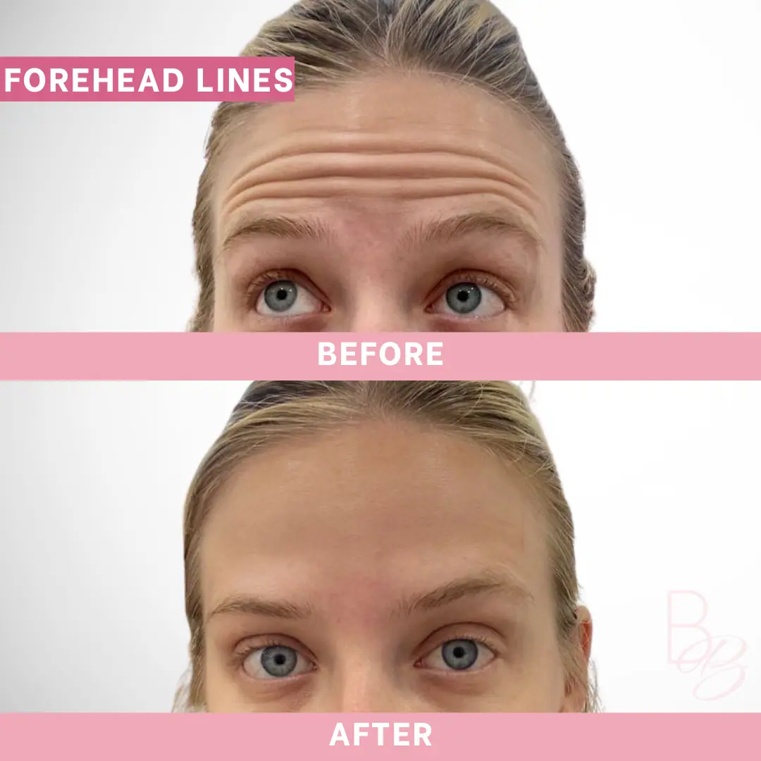 Before and After Forehead Lines | Beauty Boost Med Spa in Newport Beach, CA