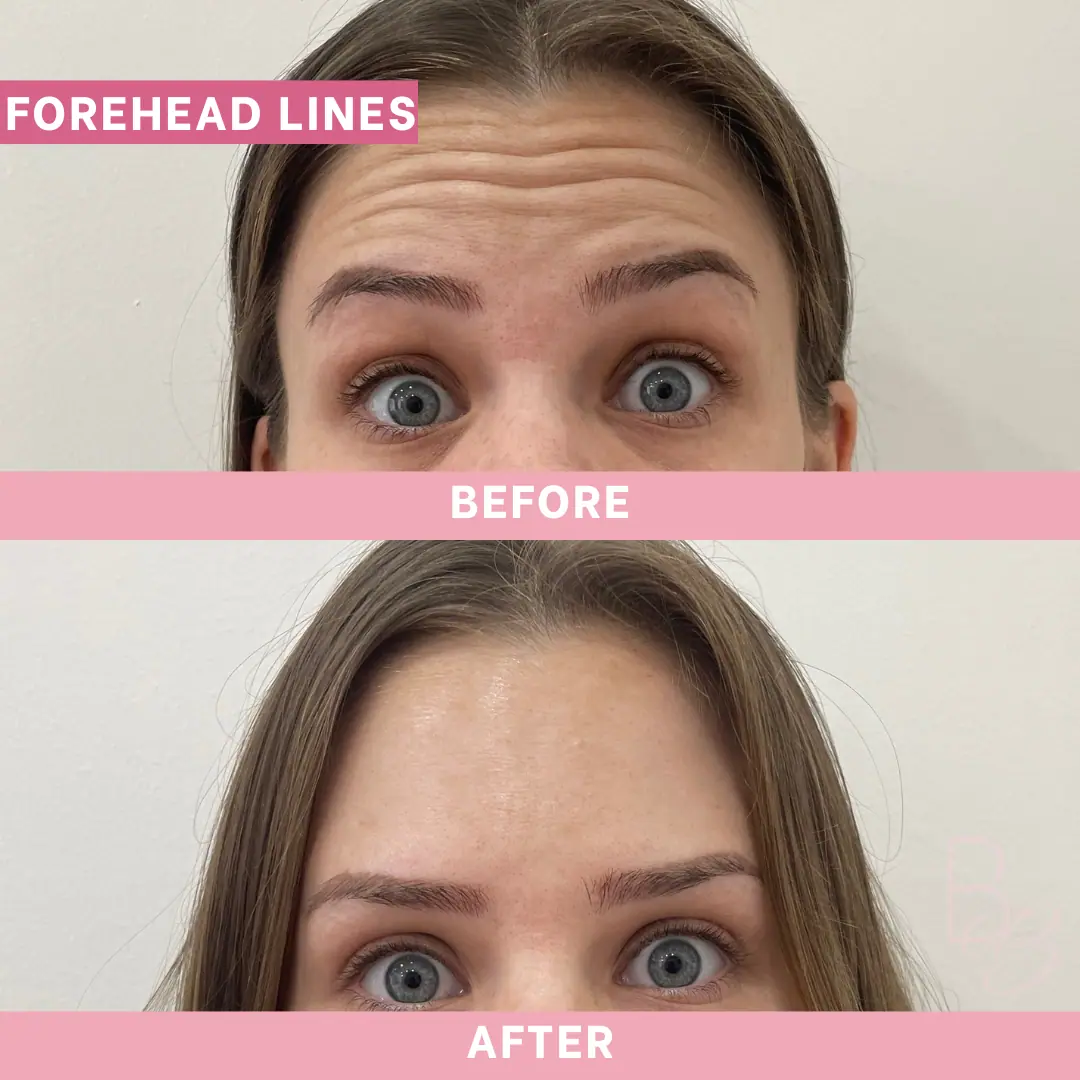 Before and After Forehead Lines | Beauty Boost Med Spa in Newport Beach, CA