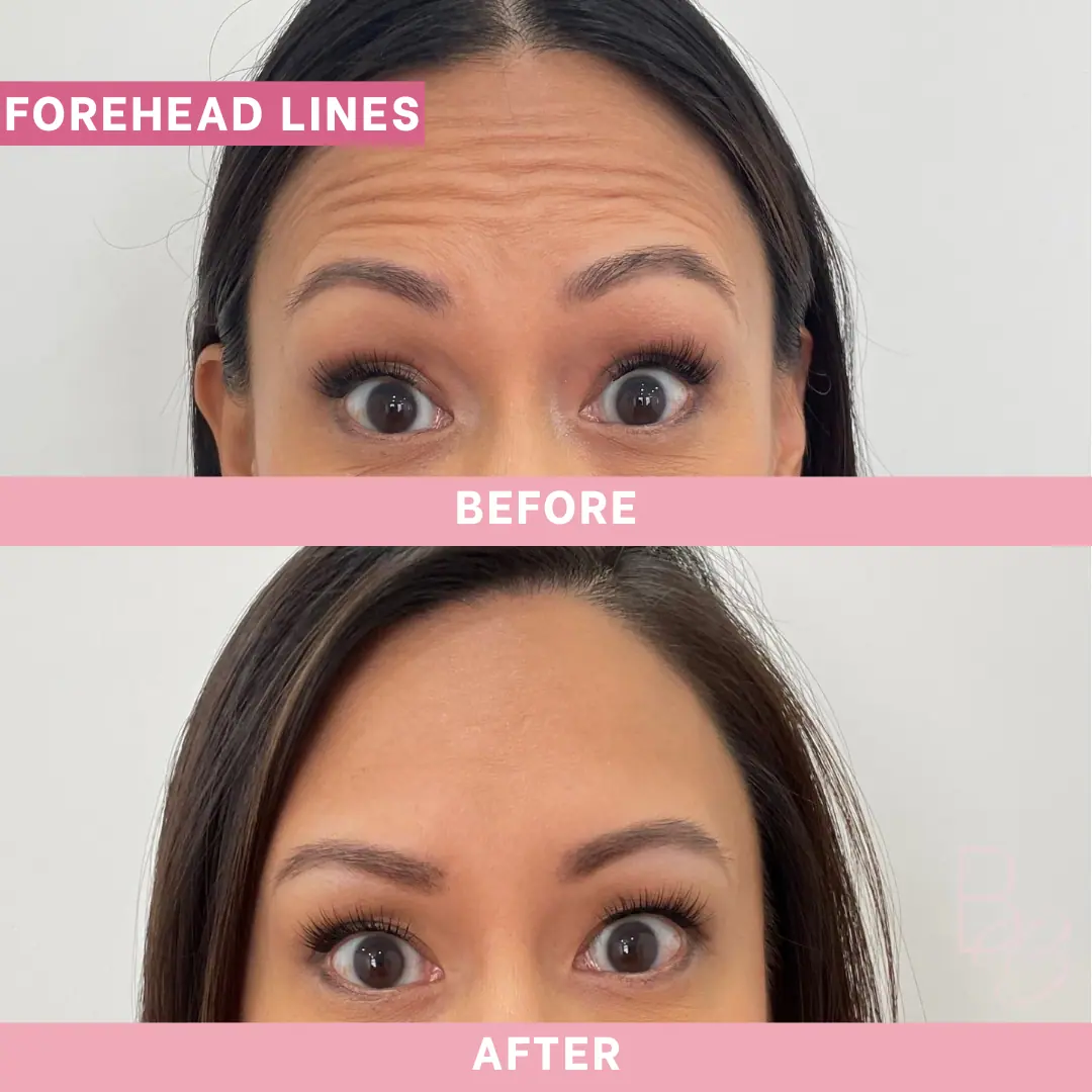 Before and After Forehead Lines | Beauty Boost Med Spa in Newport Beach, CA