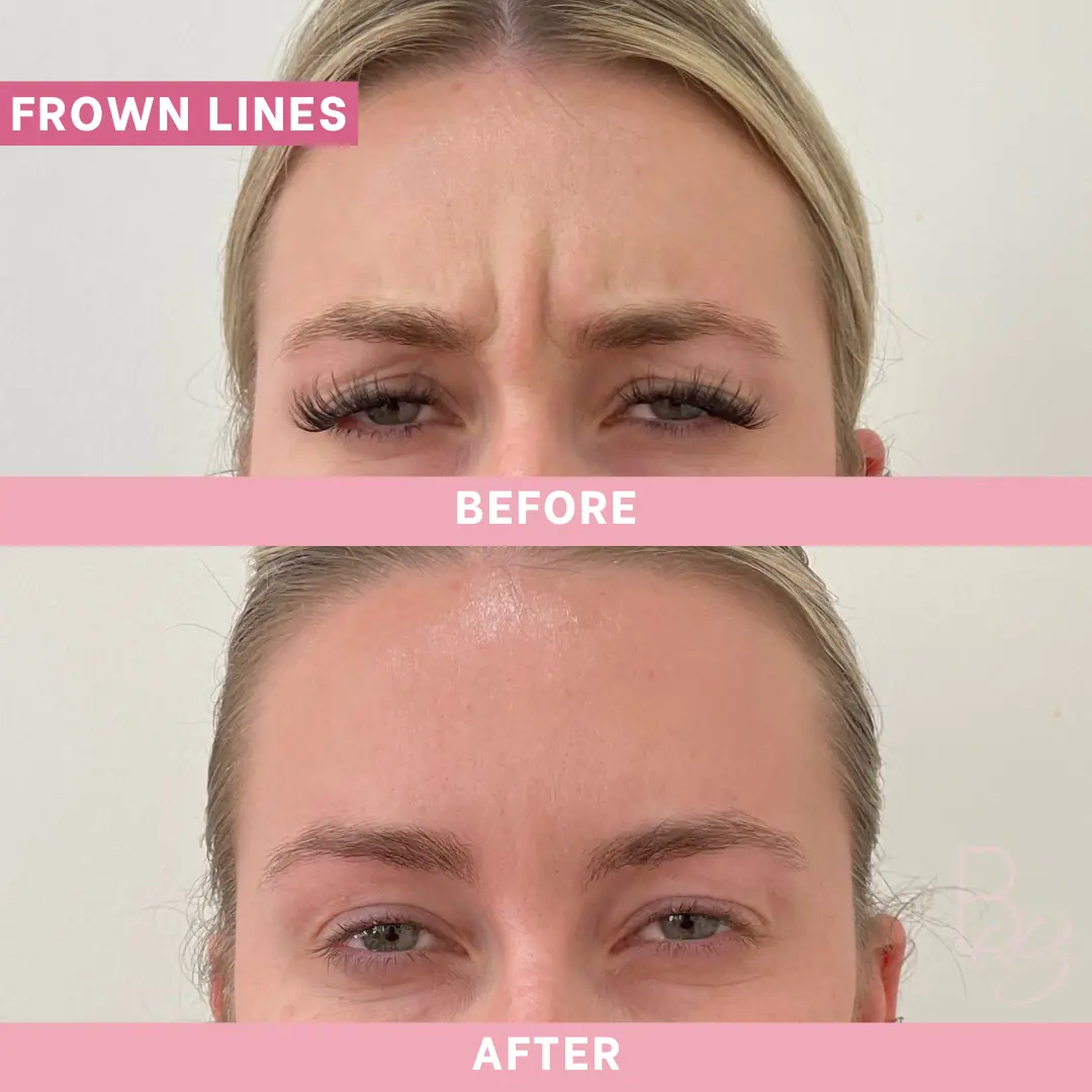 Before and After Forehead Lines | Beauty Boost Med Spa in Newport Beach, CA