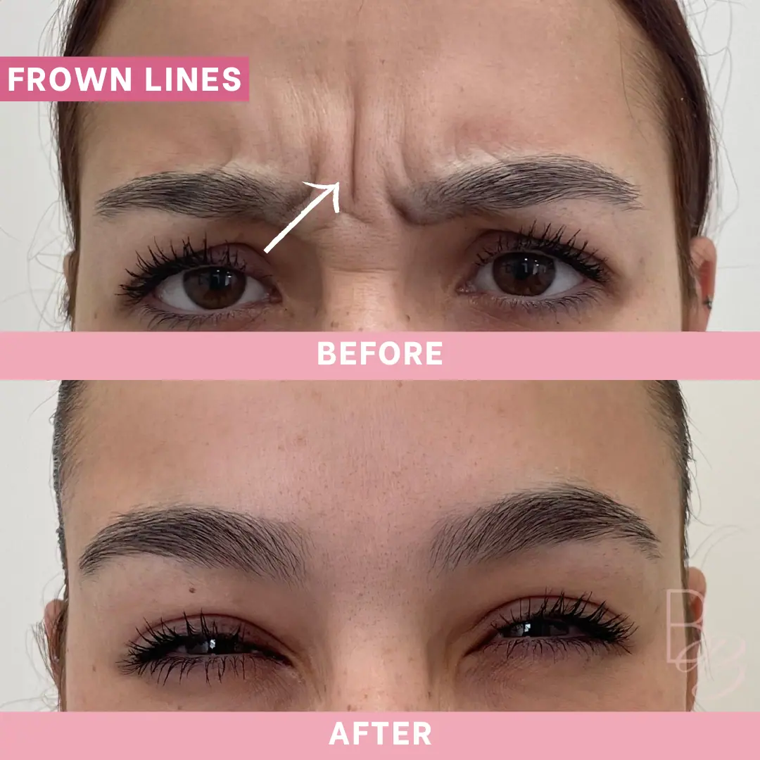 Before and After Frown Lines | Beauty Boost Med Spa in Newport Beach, CA