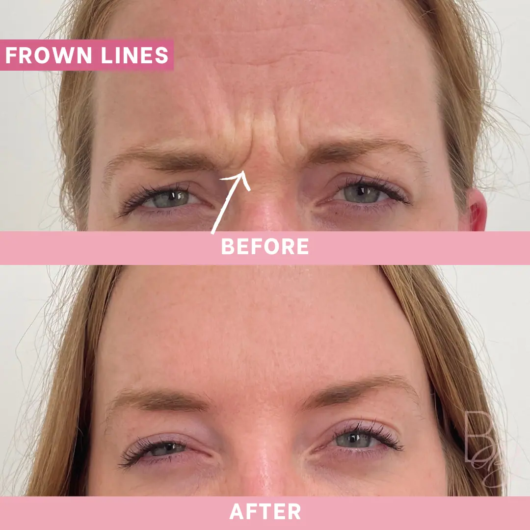 Before and After Frown Lines | Beauty Boost Med Spa in Newport Beach, CA