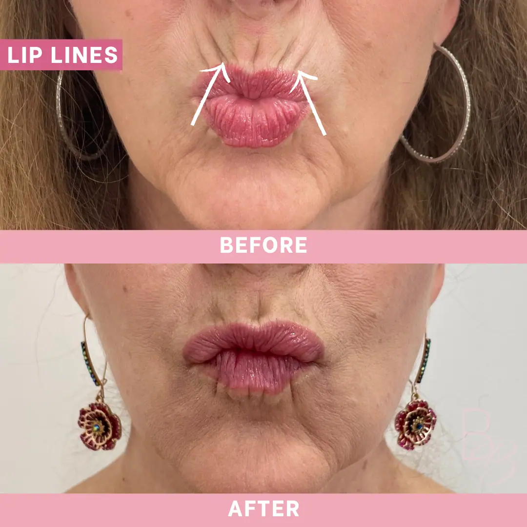 Before and After Lip Lines | Beauty Boost Med Spa in Newport Beach, CA