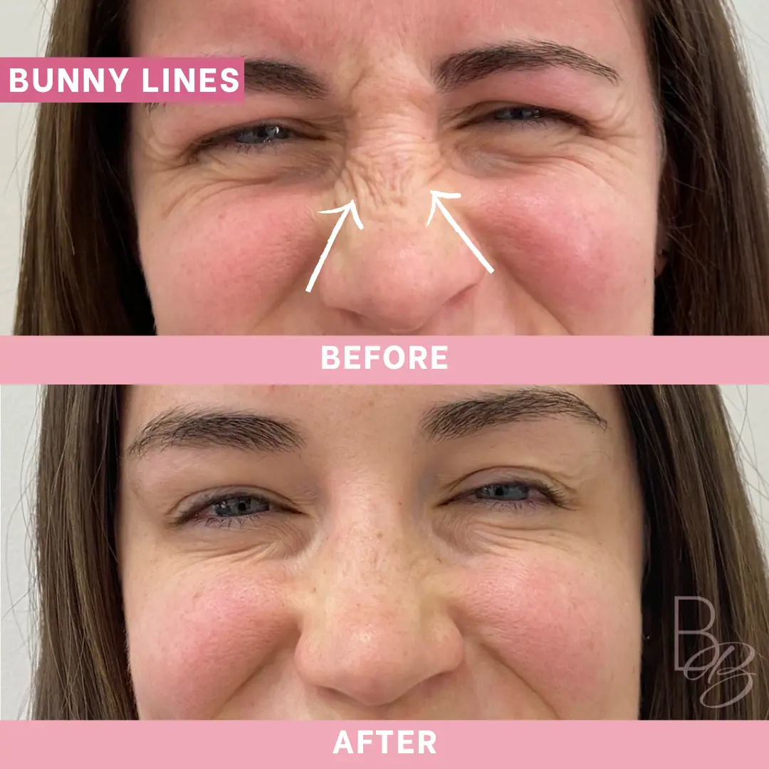 Before and After Bunny Lines | Beauty Boost Med Spa in Newport Beach, CA